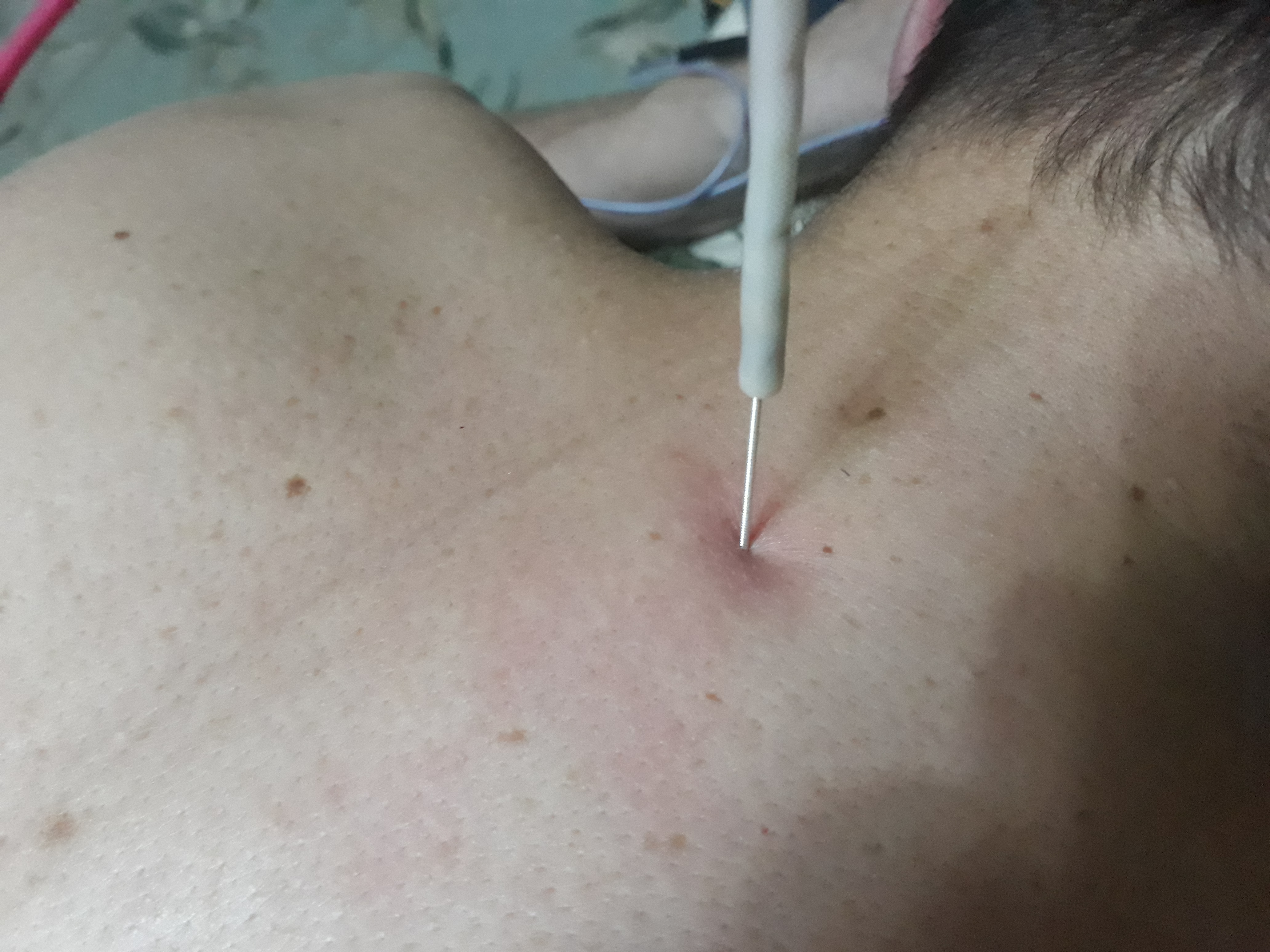 Фото Лечение шейного остеохондроза  по методике Герасимова.